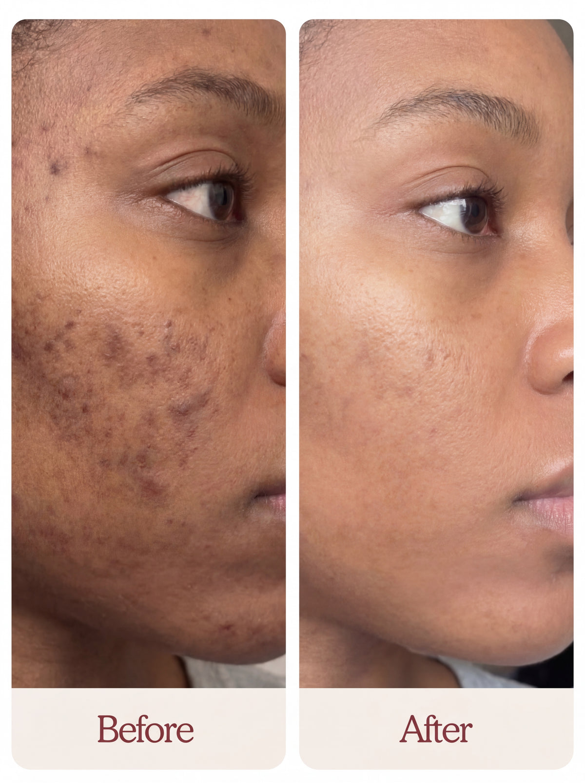 Say Goodbye to Dark Spots + Blemishes